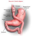 There are many potential complications and serious health risks resulting from Gastric Bypass Surgery.