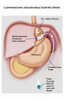 Stomach Band Surgery in Canada