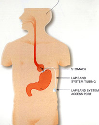 Adjustable Gastric Banding