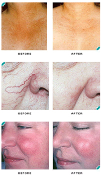 We offer cosmetic laser procedures to help treat skin problems and imperfections