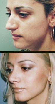 Plastic Rhinoplasty Surgery