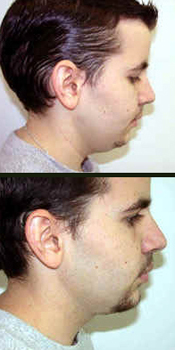 Toronto Neck Lift Surgery