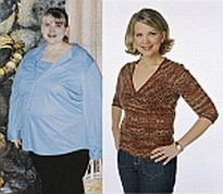 Surgery for Weight Loss